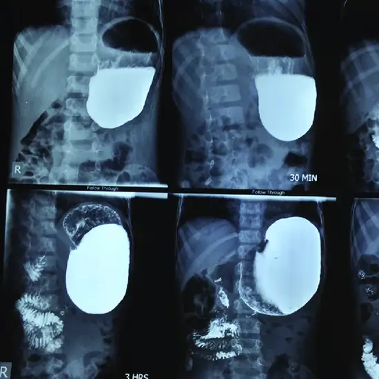 x-ray barium meal complete